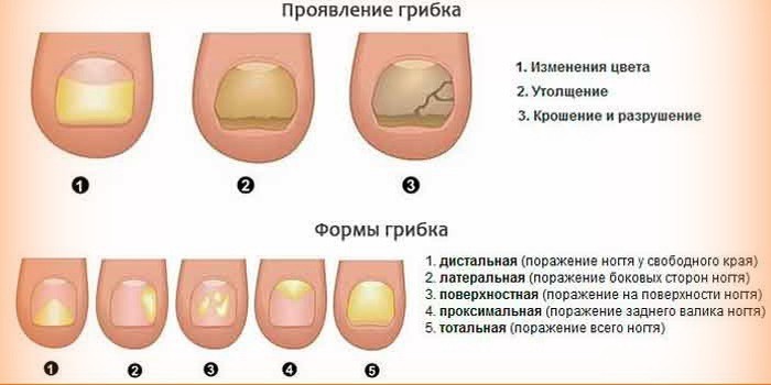 Стадии развития грибка ногтей